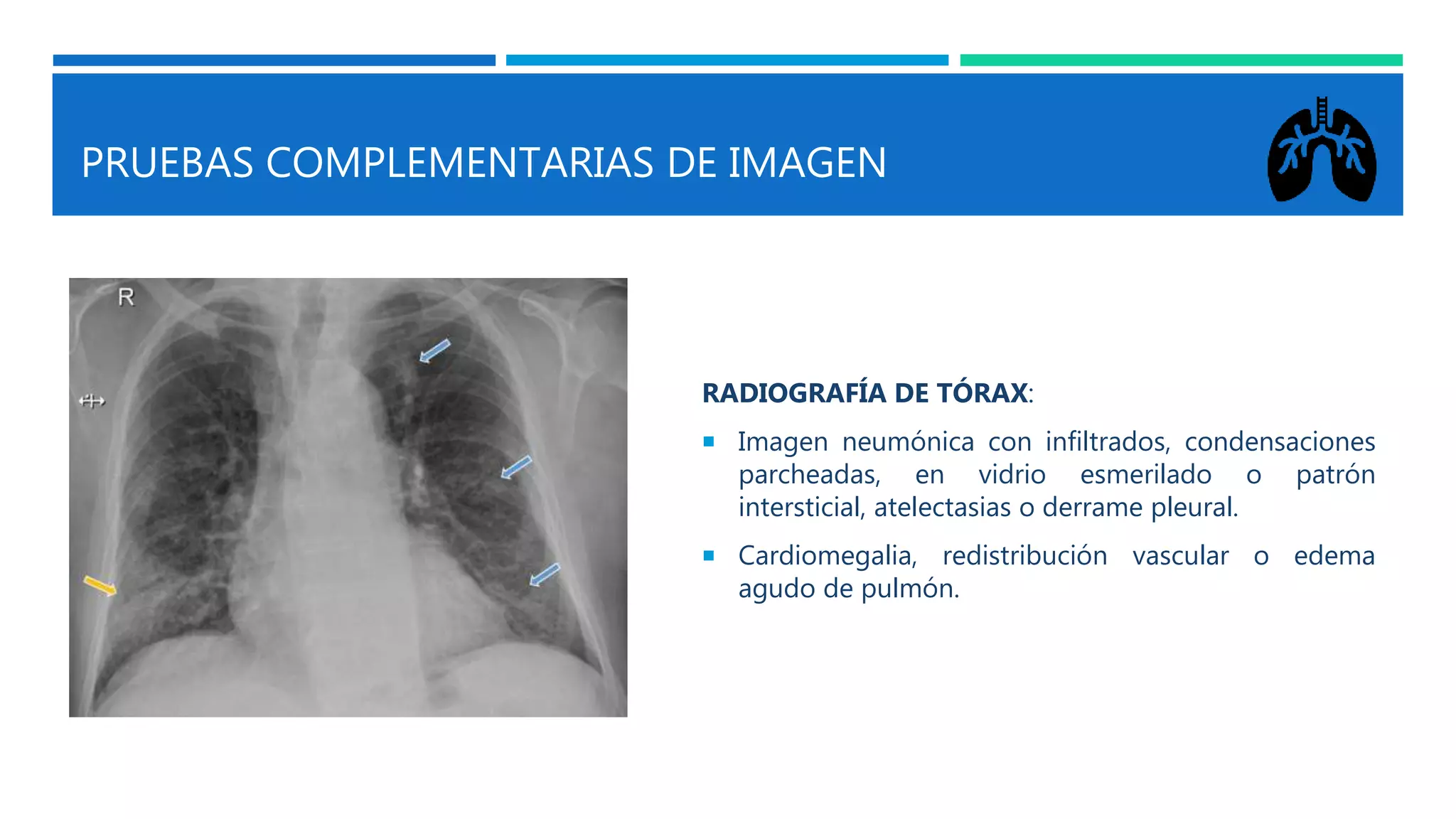 PRUEBAS COMPLEMENTARIAS DE IMAGEN
RADIOGRAFÍA DE TÓRAX:
 Imagen neumónica con infiltrados, condensaciones
parcheadas, en vidrio esmerilado o patrón
intersticial, atelectasias o derrame pleural.
 Cardiomegalia, redistribución vascular o edema
agudo de pulmón.
 