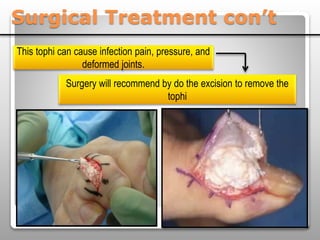 Surgical Treatment con’t
This tophi can cause infection pain, pressure, and
deformed joints.
Surgery will recommend by do the excision to remove the
tophi
 