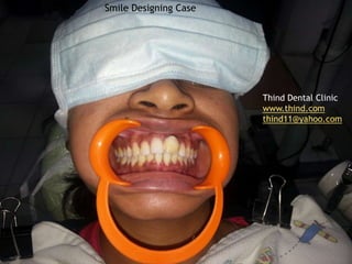 Smile Designing Case
Thind Dental Clinic
www.thind.com
thind11@yahoo.com
 