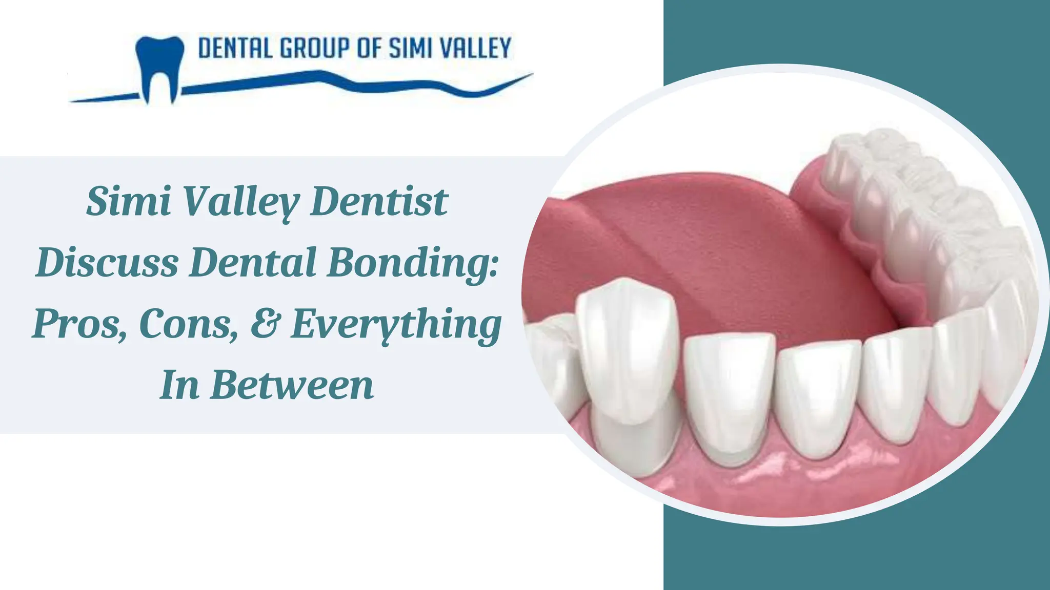 Simi Valley Dentist Discuss Dental Bonding Pros, Cons, & Everything In