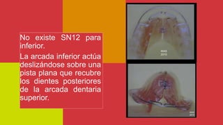 No existe SN12 para
inferior.
La arcada inferior actúa
deslizándose sobre una
pista plana que recubre
los dientes posteriores
de la arcada dentaria
superior.
 