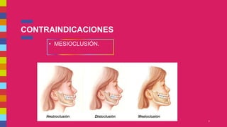 CONTRAINDICACIONES
6
• MESIOCLUSIÓN.
 