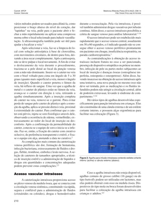 210
Medicina (Ribeirão Preto) 2012;45(2): 208-14
http://www.fmrp.usp.br/revista
Carlotti APCP.
Acesso Vascular
vários métodos podem ser usados para dilatá-la, como
posicionar o braço abaixo do nível do coração, dar
"tapinhas" na veia, pedir para o paciente abrir e fe-
char a mão repetidamente ou aplicar uma compressa
morna sobre o local selecionado para induzir vasodila-
tação. A ultrassonografia também pode ser útil para
ajudar a localizar a veia.2
Após selecionar a veia, faz-se a limpeza do lo-
cal com solução antisséptica à base de clorexidina,
com movimentos circulares, de dentro para fora, dei-
xando a área secar completamente.Após a antissepsia,
não se deve palpar o local novamente. A fim de evitar
o deslocamento da veia durante o procedimento,
traciona-se a pele distal ao local da punção venosa
com a mão não dominante. Insere-se o cateter na veia
com o bisel voltado para cima em ângulo de 5 a 30
graus (quanto mais superficial a veia, menor o ângulo
de inserção). Quando o cateter penetra o lúmen da
veia, há refluxo de sangue. Uma vez que a agulha de
metal e o cateter de plástico estão no lúmen da veia,
avança-se o cateter em direção à veia, retirando a
agulha simultaneamente. Após a inserção completa
do cateter na veia, remove-se o garrote. Para evitar
perda de sangue pelo cateter de plástico após a remo-
ção da agulha, aplica-se pressão direta à veia, proximal
à extremidade do cateter. Para confirmar que o cate-
ter está pérvio, injeta-se soro fisiológico através dele,
observando a ocorrência de edema, vermelhidão, ex-
travasamento ao redor do local de inserção ou des-
conforto. Após a confirmação da permeabilidade do
cateter, conecta-se o equipo de soro e inicia-se a infu-
são. Faz-se, então, a fixação do cateter com curativo
oclusivo, de preferência transparente e estéril, e fixa-
se o equipo em alça, anotando a data no curativo.2
As complicações mais comuns da cateterização
venosa periférica são dor, formação de hematoma,
infecção bacteriana, extravasamento de fluidos e dro-
gas, flebite, trombose, embolia e lesão nervosa. A se-
leção de cateteres de tamanhos apropriados, a técni-
ca de inserção estéril e a administração de líquidos e
drogas em quantidades e concentrações adequadas
podem prevenir estas complicações.2,3
Acesso vascular intraósseoAcesso vascular intraósseoAcesso vascular intraósseoAcesso vascular intraósseoAcesso vascular intraósseo
A cateterização intraóssea proporciona acesso
ao plexo venoso da medula óssea, que se conecta com
a circulação venosa sistêmica, constituindo via rápida,
segura e confiável para a administração de fluidos
(cristaloides ou coloides), drogas e hemoderivados
durante a ressuscitação. Pela via intraóssea, é possí-
vel também administrar drogas vasoativas por infusão
contínua.Além disso, o acesso intraósseo possibilita a
coleta de sangue venoso para análise laboratorial.1,3,4
O acesso intraósseo pode ser estabelecido mais
rapidamente que o acesso venoso central, usualmente
em 30 a 60 segundos, e é indicado quando não se con-
segue obter o acesso venoso periférico prontamente
em pacientes em choque, insuficiência respiratória, ou
parada cardiorrespiratória.1
As contraindicações à obtenção do acesso in-
traósseo incluem fratura no osso a ser puncionado,
presença de dispositivo ortopédico ou prótese no mem-
bro, infecção de pele ou partes moles subjacentes ao
local de inserção e doenças ósseas (osteogênese im-
perfeita, osteopenia e osteopetrose). Além disso, ha-
vendo insucesso na obtenção do acesso intraósseo após
uma tentativa, uma nova punção no mesmo osso não
deve ser tentada, pois as medicações e os fluidos in-
fundidos podem não atingir a circulação central, além
de poderem extravasar, levando à síndrome de com-
partimento.1,3,4
Há vários tipos de agulhas desenvolvidas espe-
cificamente para punção intraóssea em crianças. Elas
são constituídas de uma cânula externa e de um estilete
cortante interno, e possuem alças ergonômicas para
facilitar sua colocação (Figura 3).
Figura 3: Agulha para infusão intraóssea contendo estilete cortante
interno (acima) e cânula externa (abaixo).
Caso a agulha intraóssea não esteja disponível,
agulhas comuns de grosso calibre (16 gauge) ou do
tipo butterfly podem ser utilizadas em lactentes, mas
elas podem obstruir com osso ou medula óssea. Dis-
positivos do tipo mola ou broca foram desenvolvidos
para facilitar a colocação da agulha intraóssea em
crianças e adultos.4,5
 