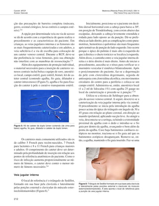 212
Medicina (Ribeirão Preto) 2012;45(2): 208-14
http://www.fmrp.usp.br/revista
Carlotti APCP.
Acesso Vascular
ção das precauções de barreira completa (máscara,
gorro, avental cirúrgico, luvas estéreis e campos esté-
reis).3,6
A opção por determinada veia ou via de acesso
se dá de acordo com a experiência de quem realiza o
procedimento e as características do paciente. Em
crianças, as veias jugulares internas e as femorais são
as mais frequentemente cateterizadas e em adultos, a
veia subclávia é a via de escolha para colocação de
um cateter venoso central. Durante a RCP, deve-se
dar preferência às veias femorais, pois sua obtenção
não interfere com as manobras de ressuscitação.1,6
Além dos equipamentos de proteção individual,
o material necessário para a inserção de cateteres ve-
nosos centrais inclui bolsa e equipo de soro, anestési-
co local, campo estéril, gaze estéril, bisturi, kit de ca-
teter central (contendo agulha, fio guia, dilatador e
cateter intravenoso) (Figura 5), agulha e fio para fixa-
ção do cateter à pele e curativo transparente estéril.
Figura 5: Kit de cateter de duplo lúmen contendo (de cima para
baixo) agulha, fio guia, dilatador e cateter de duplo lúmen.
Figura 6: Triângulo de Sedillot formado em sua base pela clavícula
e lateralmente pelas porções esternal e clavicular do músculo
esternocleidomastoideo. A seta aponta o local de referência para
a punção da veia jugular interna.
Os cateteres mais comumente utilizados são os
de calibre 5 French para recém-nascidos, 7 French
para lactentes e 8 a 11 French para crianças maiores
e adultos. O comprimento do cateter deve ser deter-
minado pela profundidade de inserção em relação aos
pontos de referência anatômicos do paciente. Como o
risco de infecção aumenta proporcionalmente ao nú-
mero de lúmens, o cateter deve conter o menor nú-
mero de lúmens necessário.3,6
Veia jugular interna
O local de referência é o triângulo de Sedillot,
formado em sua base pela clavícula e lateralmente
pelas porções esternal e clavicular do músculo ester-
nocleidomastoideo (Figura 6).3
Inicialmente, posiciona-se o paciente em decú-
bito dorsal horizontal com a cabeça para baixo a 30º,
em posição de Trendelenburg, com coxim abaixo das
escápulas, deixando a cabeça levemente estendida e
rodada para lado oposto ao da punção. Dá-se prefe-
rência ao lado direito, pois as complicações como pneu-
motórax, hemotórax e quilotórax são mais frequentes
após tentativas de punção do lado esquerdo. Isto ocorre
porque o ápice do pulmão é mais alto à esquerda do
que à direita e o ducto torácico se localiza à esquerda.
Além disso, o caminho entre a veia jugular interna di-
reita e o átrio direito é mais direto. Antes de iniciar o
procedimento, ausculta-se o tórax para verificar se o
murmúrio vesicular é simétrico bilateralmente. Após
o posicionamento do paciente, faz-se a degermação
da pele com clorexidina degermante, seguida de
antissepsia com clorexidina alcoólica, em movimentos
circulares do centro para a periferia e coloca-se um
campo estéril. Administra-se, então, anestésico local
(1 a 2 ml de lidocaína 1%) com agulha 25 gauge no
local da cateterização e procede-se à punção.1,3,6
Utiliza-se a técnica de Seldinger para a obten-
ção do acesso venoso central. A seguir, descreve-se a
cateterização da veia jugular interna pela via central.
O procedimento se inicia pela introdução da agulha
pouco acima do ápice do triângulo em ângulo de 30 a
45 graus em relação ao plano coronal, em direção ao
mamilo ipsilateral, aplicando sucção leve.Ao atingir a
veia, desconecta-se a seringa, ocluindo a extremidade
proximal da agulha com o dedo e introduz-se o fio
guia por dentro da agulha, avançando-o bem além da
ponta da agulha. Caso haja batimentos cardíacos ec-
tópicos no monitor, traciona-se o fio guia até que os
batimentos ectópicos desapareçam. Remove-se, en-
tão, a agulha, mantendo o fio guia inserido. Faz-se uma
 