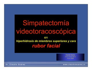Simpatectomía
videotoracoscópica
en
hiperhidrosis de miembros superiores y cara
rubor facial
Claudio Suárez
Clínica Santa María
Enero 2008
 