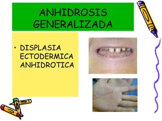 ANHIDROSIS
GENERALIZADA
• DISPLASIA
ECTODERMICA
ANHIDROTICA
 