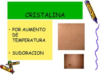 CRISTALINA
• POR AUMENTO
DE
TEMPERATURA
• SUDORACION
 