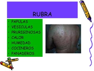 RUBRA
• PAPULAS
• VESICULAS
• PRURIGINOSAS
• CALOR
• HUMEDAD
• COCINEROS
• PANADEROS
 
