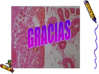 Simpaticectomia Videotoracoscópica.ppt