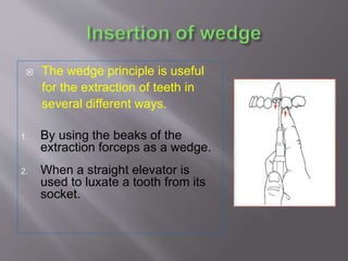  The wedge principle is useful
for the extraction of teeth in
several different ways.
1. By using the beaks of the
extraction forceps as a wedge.
2. When a straight elevator is
used to luxate a tooth from its
socket.
 