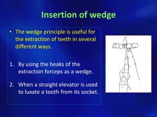 Insertion of wedge
• The wedge principle is useful for
  the extraction of teeth in several
  different ways.

1. By using the beaks of the
   extraction forceps as a wedge.

2. When a straight elevator is used
   to luxate a tooth from its socket.
 