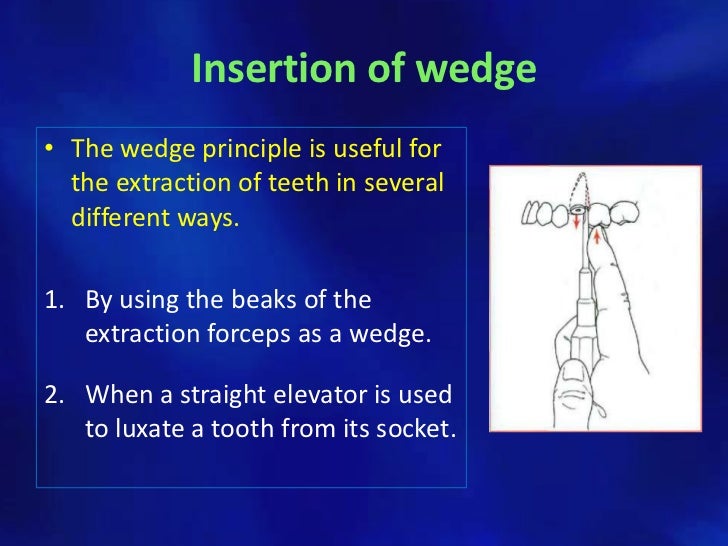 Simple tooth extraction technique