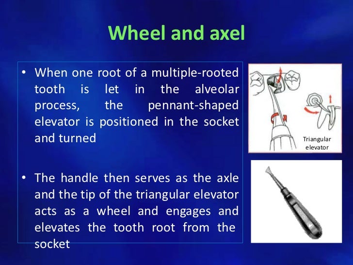 Simple tooth extraction technique