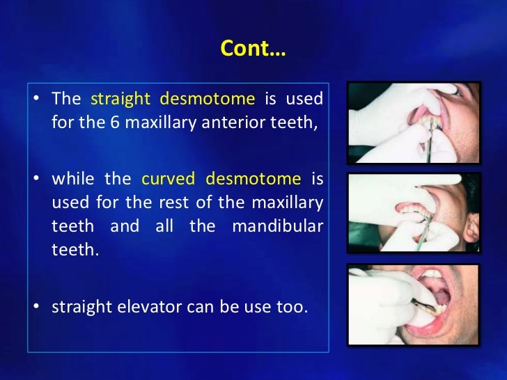 Simple tooth extraction technique