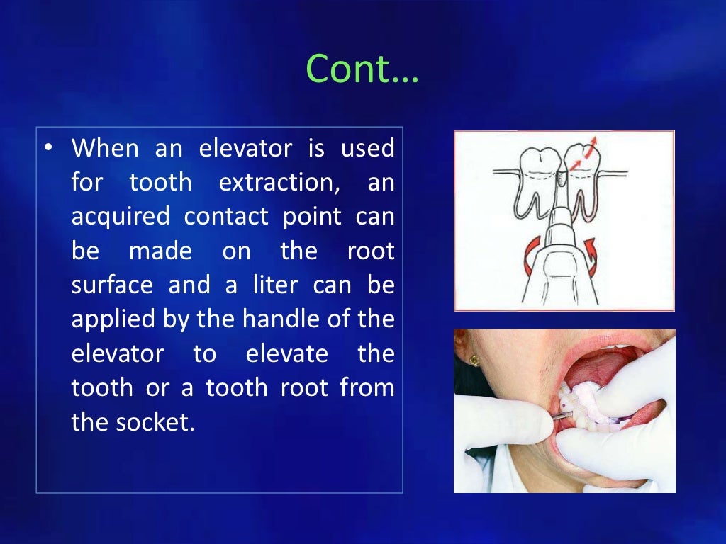 Simple tooth extraction technique