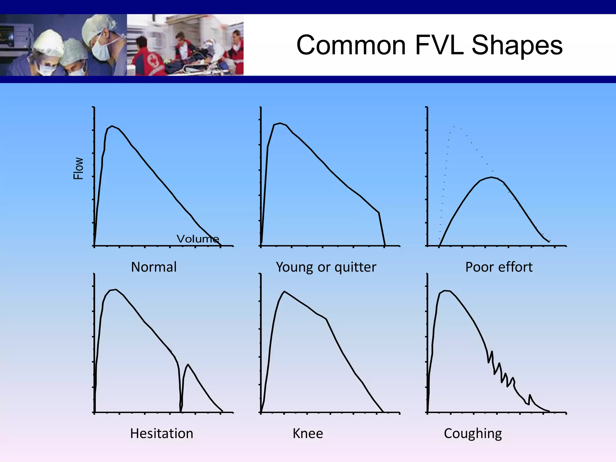 Flow

Common FVL Shapes

Volume

Normal

Hesitation

Young or quitter

Knee

Poor effort

Coughing

 