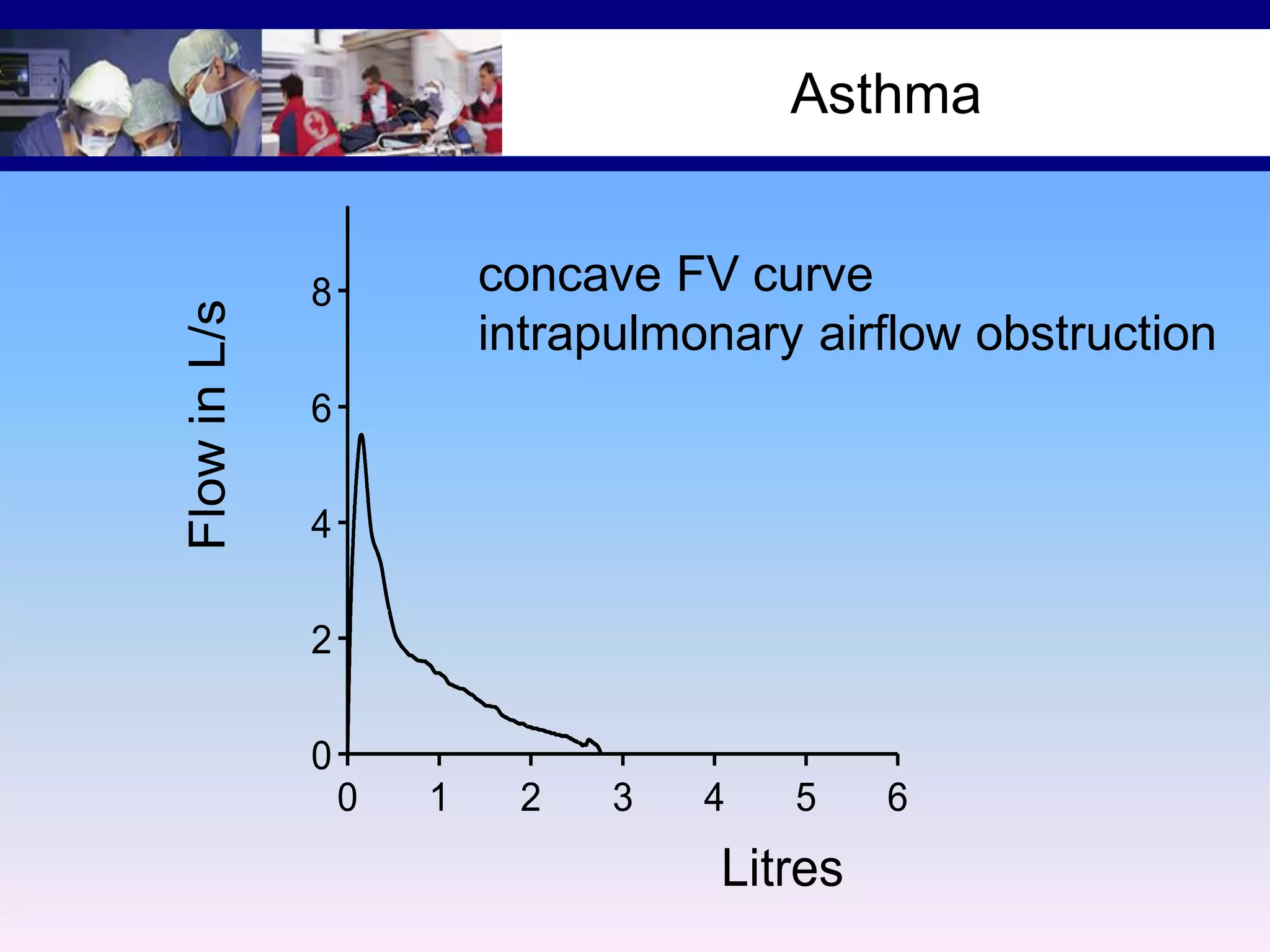 12

Asthma

Flow in L/s

10

concave FV curve
intrapulmonary airflow obstruction

8
6
4
2
0
0

1

2

3

4

5

Litres

6

 