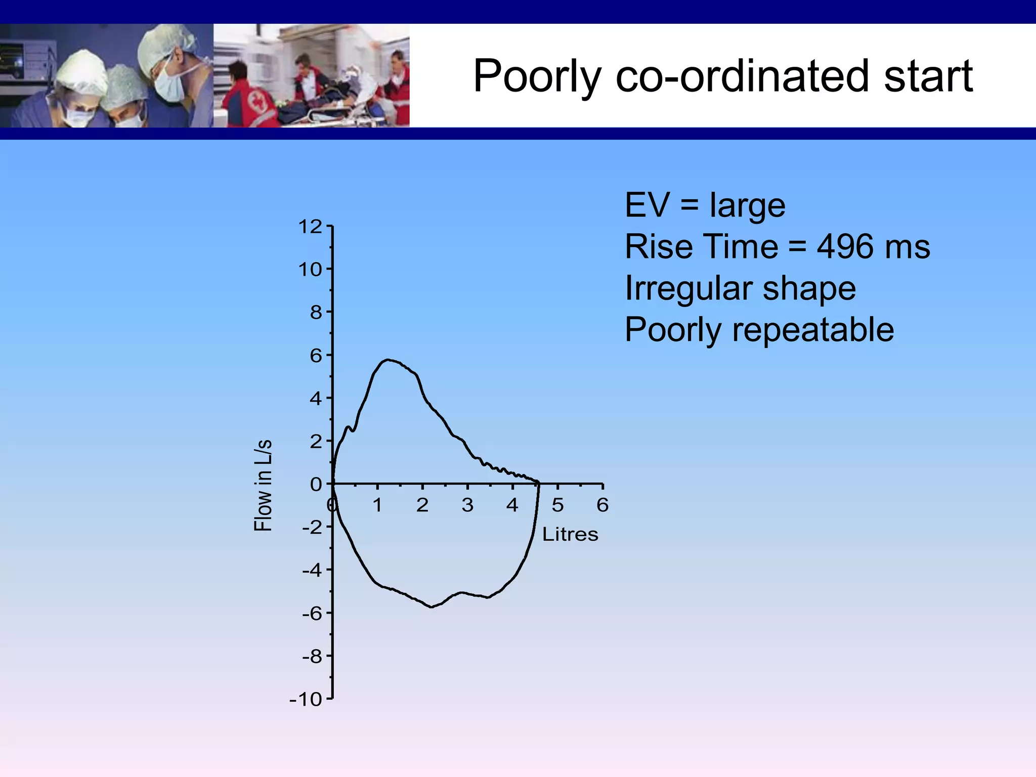 Poorly co-ordinated start
EV = large
Rise Time = 496 ms
Irregular shape
Poorly repeatable

12
10
8
6

Flow in L/s

4
2
0
0
-2
-4
-6
-8
-10

1

2

3

4

5

6

Litres

 