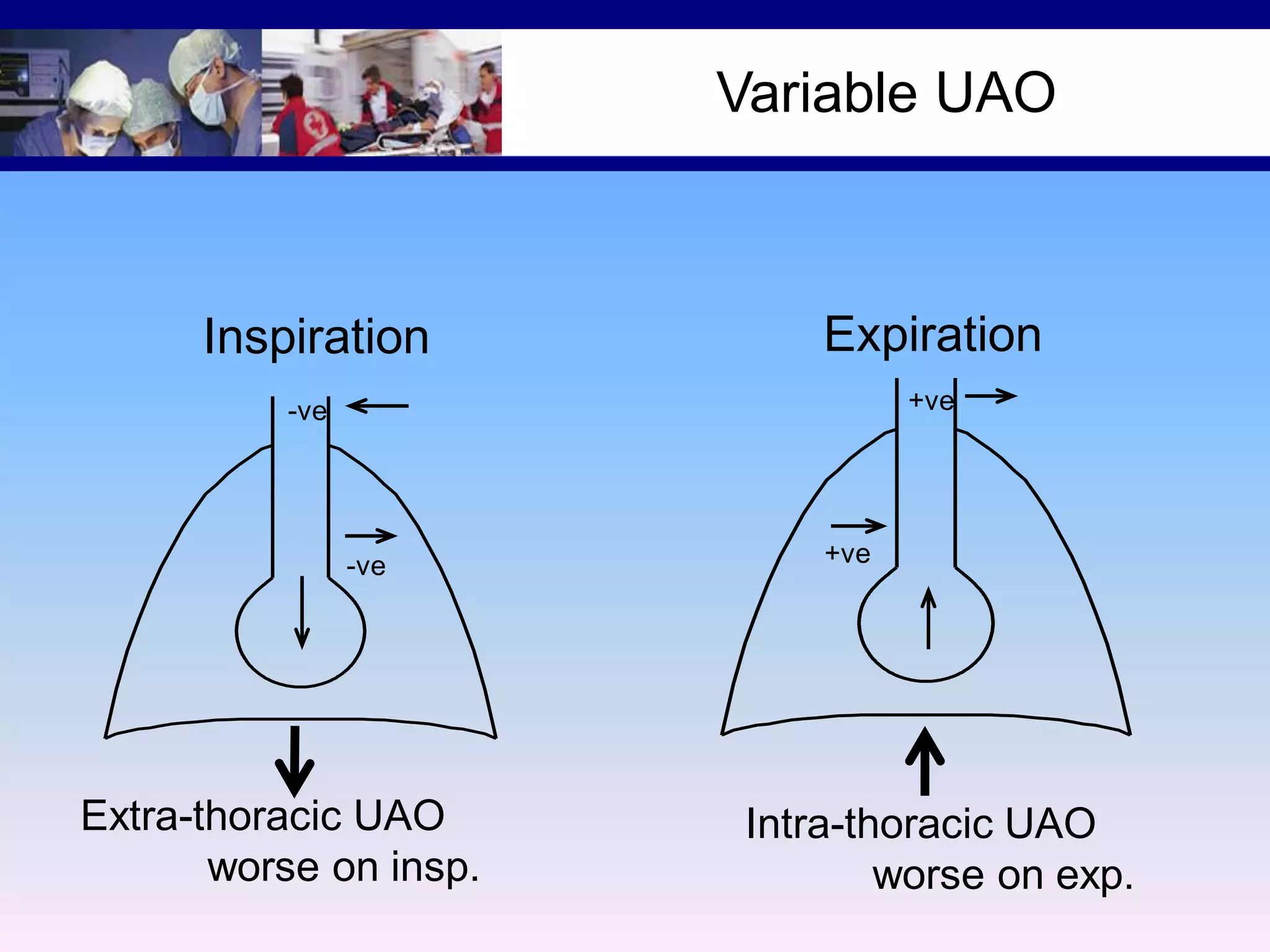 Variable UAO

Inspiration

Expiration
+ve

-ve

-ve

Extra-thoracic UAO
worse on insp.

+ve

Intra-thoracic UAO
worse on exp.

 