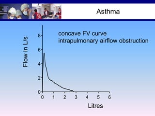 12

Asthma

Flow in L/s

10

concave FV curve
intrapulmonary airflow obstruction

8
6
4
2
0
0

1

2

3

4

5

Litres

6

 