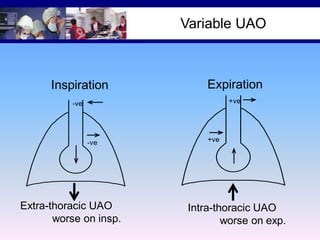 Variable UAO

Inspiration

Expiration
+ve

-ve

-ve

Extra-thoracic UAO
worse on insp.

+ve

Intra-thoracic UAO
worse on exp.

 