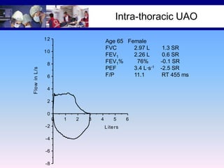 Intra-thoracic UAO
12

Age 65 Female
FVC
2.97 L
FEV1
2.26 L
FEV1%
76%
PEF
3.4 L·s-1
F/P
11.1

10

Flo w in L /s

8
6
4
2
0
0
-2
-4
-6
-8

1

2

3

4

5
L ite rs

6

1.3 SR
0.6 SR
-0.1 SR
-2.5 SR
RT 455 ms

 