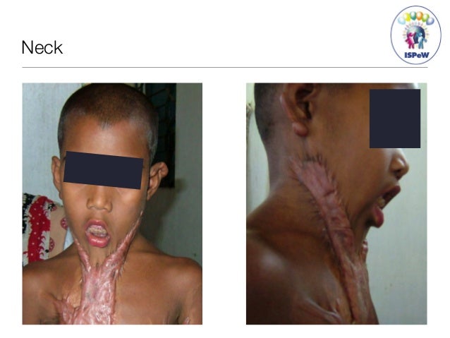 basic surgery for burn scars during humanitarian mission