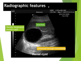 Radiographic features , US:
Anechoic
Enhanced through-transmission
Sharply marginated,
smooth walls
 