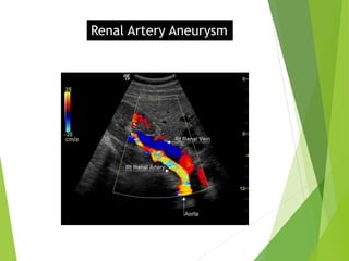 Renal Artery Aneurysm
 