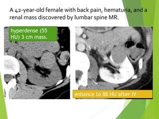 A 42-year-old female with back pain, hematuria, and a
renal mass discovered by lumbar spine MR.
hyperdense (55
HU) 3 cm mass.
enhance to 88 HU after IV
contrast
 