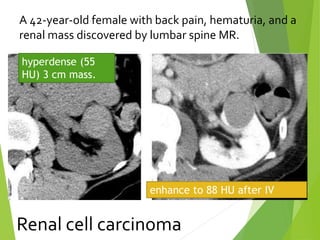 A 42-year-old female with back pain, hematuria, and a
renal mass discovered by lumbar spine MR.
hyperdense (55
HU) 3 cm mass.
enhance to 88 HU after IV
contrast
Renal cell carcinoma
 