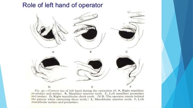 Tooth Extraction Simple Technique | PPTX | Dental Health | Diseases and ...