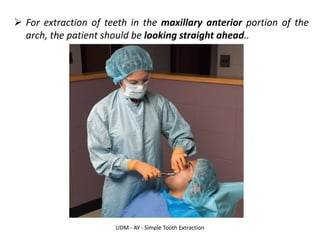 UDM - AY - Simple Tooth Extraction
➢ For extraction of teeth in the maxillary anterior portion of the
arch, the patient should be looking straight ahead..
 