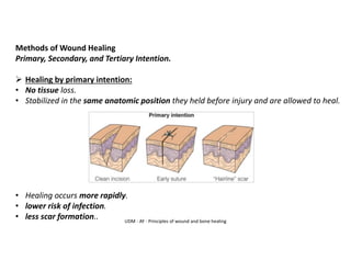 UDM - AY - Principles of wound and bone healing
Methods of Wound Healing
Primary, Secondary, and Tertiary Intention.
➢ Healing by primary intention:
• No tissue loss.
• Stabilized in the same anatomic position they held before injury and are allowed to heal.
• Healing occurs more rapidly.
• lower risk of infection.
• less scar formation..
 