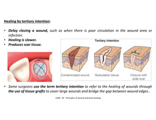UDM - AY - Principles of wound and bone healing
Healing by tertiary intention:
• Delay closing a wound, such as when there is poor circulation in the wound area or
infection.
• Healing is slower.
• Produces scar tissue.
• Some surgeons use the term tertiary intention to refer to the healing of wounds through
the use of tissue grafts to cover large wounds and bridge the gap between wound edges..
 