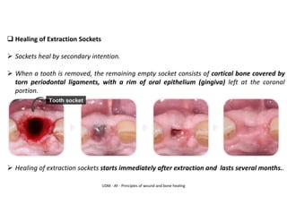 UDM - AY - Principles of wound and bone healing
❑ Healing of Extraction Sockets
➢ Sockets heal by secondary intention.
➢ When a tooth is removed, the remaining empty socket consists of cortical bone covered by
torn periodontal ligaments, with a rim of oral epithelium (gingiva) left at the coronal
portion.
➢ Healing of extraction sockets starts immediately after extraction and lasts several months..
 