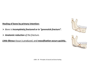 UDM - AY - Principles of wound and bone healing
Healing of bone by primary intention:
➢ Bone is incompletely fractured or in “greenstick fracture”.
➢ Anatomic reduction of the fracture.
Little fibrous tissue is produced, and reossification occurs quickly..
 