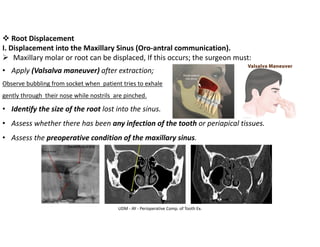 ❖ Root Displacement
I. Displacement into the Maxillary Sinus (Oro-antral communication).
➢ Maxillary molar or root can be displaced, If this occurs; the surgeon must:
• Apply (Valsalva maneuver) after extraction;
Observe bubbling from socket when patient tries to exhale
gently through their nose while nostrils are pinched.
• Identify the size of the root lost into the sinus.
• Assess whether there has been any infection of the tooth or periapical tissues.
• Assess the preoperative condition of the maxillary sinus.
UDM - AY - Perioperative Comp. of Tooth Ex.
 