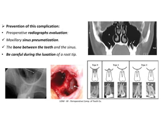 ➢ Prevention of this complication:
• Preoperative radiographs evaluation:
✓ Maxillary sinus pneumatization.
✓ The bone between the teeth and the sinus.
• Be careful during the luxation of a root tip.
UDM - AY - Perioperative Comp. of Tooth Ex.
 