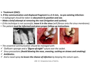 UDM - AY - Perioperative Comp. of Tooth Ex.
➢ Treatment (OAC):
1. If the communication and displaced fragment is a 2-3 mm, no pre-existing infection:
• A radiograph should be taken to document its position and size.
• Make a brief attempt at removing the root (Irrigation and suction).
• If this technique is not successful, leave it in the sinus (will fibrose onto the sinus membrane).
• The patient must be informed and given proper follow-up instructions.
• The oroantral communication should be managed with:
✓ Gelfoam sponge and a “figure-of-eight” suture over the socket.
✓ Sinus precautions (Avoid blowing the nose, sneezing, sucking on straws and smoking).
✓ Antibiotics.
✓ And a nasal spray to lessen the chance of infection by keeping the ostium open..
 