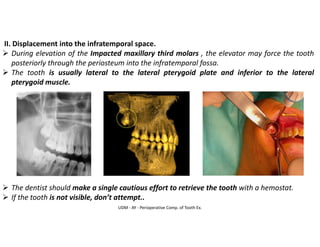 UDM - AY - Perioperative Comp. of Tooth Ex.
II. Displacement into the infratemporal space.
➢ During elevation of the Impacted maxillary third molars , the elevator may force the tooth
posteriorly through the periosteum into the infratemporal fossa.
➢ The tooth is usually lateral to the lateral pterygoid plate and inferior to the lateral
pterygoid muscle.
➢ The dentist should make a single cautious effort to retrieve the tooth with a hemostat.
➢ If the tooth is not visible, don’t attempt..
 