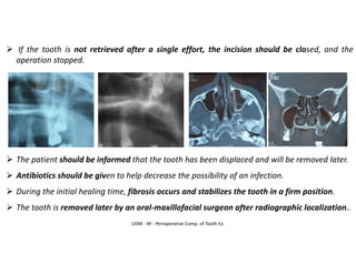 UDM - AY - Perioperative Comp. of Tooth Ex.
➢ If the tooth is not retrieved after a single effort, the incision should be closed, and the
operation stopped.
➢ The patient should be informed that the tooth has been displaced and will be removed later.
➢ Antibiotics should be given to help decrease the possibility of an infection.
➢ During the initial healing time, fibrosis occurs and stabilizes the tooth in a firm position.
➢ The tooth is removed later by an oral-maxillofacial surgeon after radiographic localization..
 