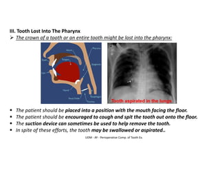 UDM - AY - Perioperative Comp. of Tooth Ex.
III. Tooth Lost Into The Pharynx
➢ The crown of a tooth or an entire tooth might be lost into the pharynx:
▪ The patient should be placed into a position with the mouth facing the floor.
▪ The patient should be encouraged to cough and spit the tooth out onto the floor.
▪ The suction device can sometimes be used to help remove the tooth.
▪ In spite of these efforts, the tooth may be swallowed or aspirated..
 