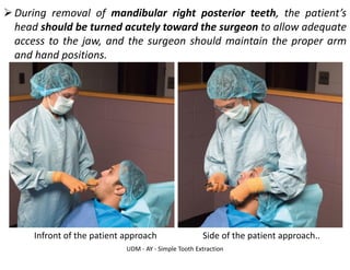 UDM - AY - Simple Tooth Extraction
➢During removal of mandibular right posterior teeth, the patient’s
head should be turned acutely toward the surgeon to allow adequate
access to the jaw, and the surgeon should maintain the proper arm
and hand positions.
Infront of the patient approach Side of the patient approach..
 