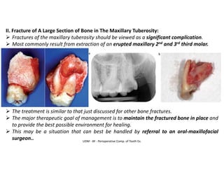 UDM - AY - Perioperative Comp. of Tooth Ex.
II. Fracture of A Large Section of Bone in The Maxillary Tuberosity:
➢ Fractures of the maxillary tuberosity should be viewed as a significant complication.
➢ Most commonly result from extraction of an erupted maxillary 2nd and 3rd third molar.
➢ The treatment is similar to that just discussed for other bone fractures.
➢ The major therapeutic goal of management is to maintain the fractured bone in place and
to provide the best possible environment for healing.
➢ This may be a situation that can best be handled by referral to an oral-maxillofacial
surgeon..
 