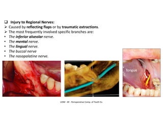 ❑ Injury to Regional Nerves:
➢ Caused by reflecting flaps or by traumatic extractions.
➢ The most frequently involved specific branches are:
• The inferior alveolar nerve.
• The mental nerve.
• The lingual nerve.
• The buccal nerve
• The nasopalatine nerve.
UDM - AY - Perioperative Comp. of Tooth Ex.
 