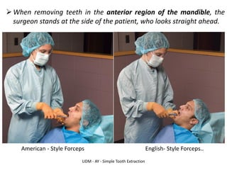 UDM - AY - Simple Tooth Extraction
➢When removing teeth in the anterior region of the mandible, the
surgeon stands at the side of the patient, who looks straight ahead.
American - Style Forceps English- Style Forceps..
 