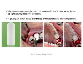 UDM - AY - Postoperative Comp. of Tooth Ex.
✓ This material is placed in the extraction socket and is held in place with a figure-
of-eight suture placed over the socket.
✓ A gauze pack is then placed over the top of the socket and is held with pressure.
 