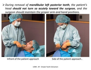 UDM - AY - Simple Tooth Extraction
➢During removal of mandibular left posterior teeth, the patient’s
head should not turn so acutely toward the surgeon, and the
surgeon should maintain the proper arm and hand positions.
Infront of the patient approach Side of the patient approach..
 