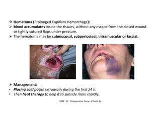 UDM - AY - Postoperative Comp. of Tooth Ex.
❖ Hematoma (Prolonged Capillary Hemorrhage):
➢ blood accumulates inside the tissues, without any escape from the closed wound
or tightly sutured flaps under pressure.
➢ The hematoma may be submucosal, subperiosteal, intramuscular or fascial.
➢ Management:
• Placing cold packs extraorally during the first 24 h.
• Then heat therapy to help it to subside more rapidly..
 